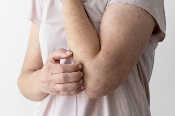 coceira e oleos essenciais para eczema
